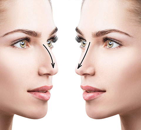 Rhinoplastie Esth Tique Chirurgie Du Nez